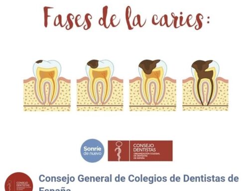 FASES DE LAS CARIES